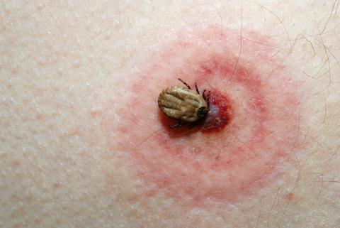 Lyme Disease Symptoms, Treatment, Pictures, Tests & Prevention