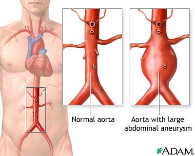 ruptured  aorta