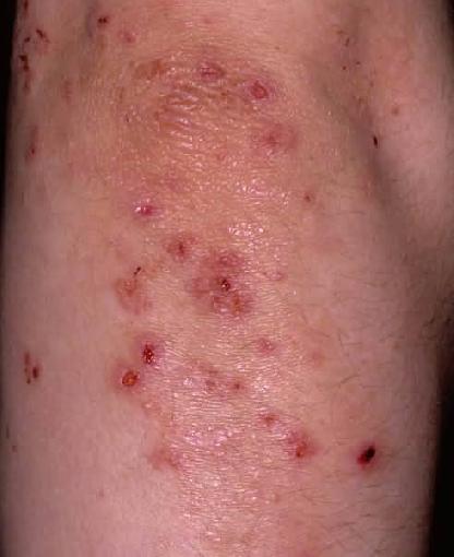 herpetic dermatitis #11