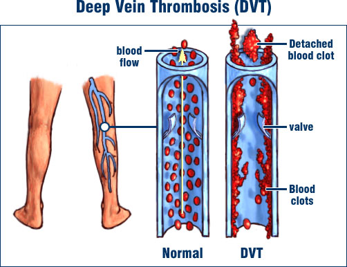 Image result for Deep Vein Thrombosis